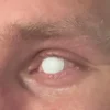 Crazylinser Blind White